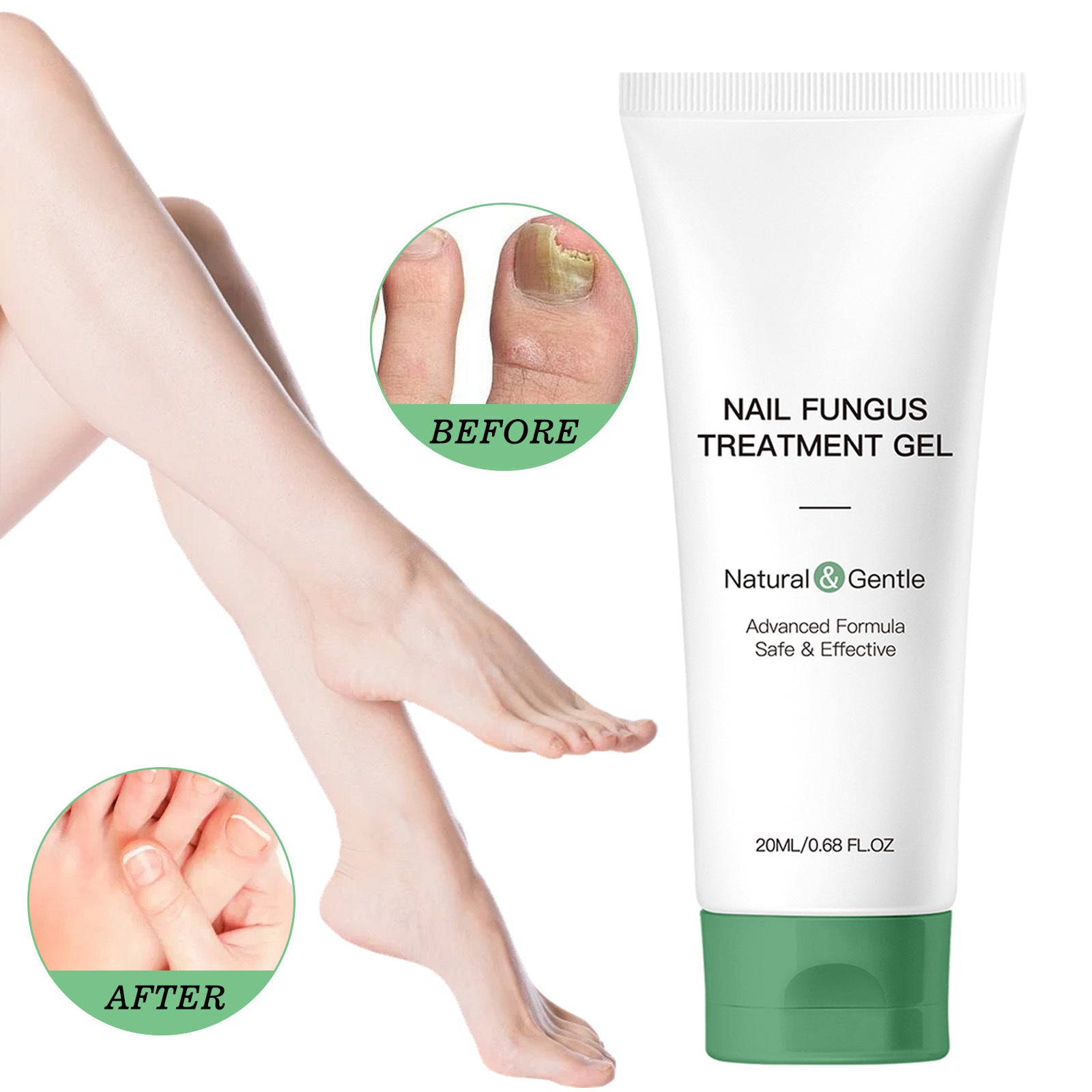 Nail fungus treatment gel with 'Before' and 'After' images of a foot.